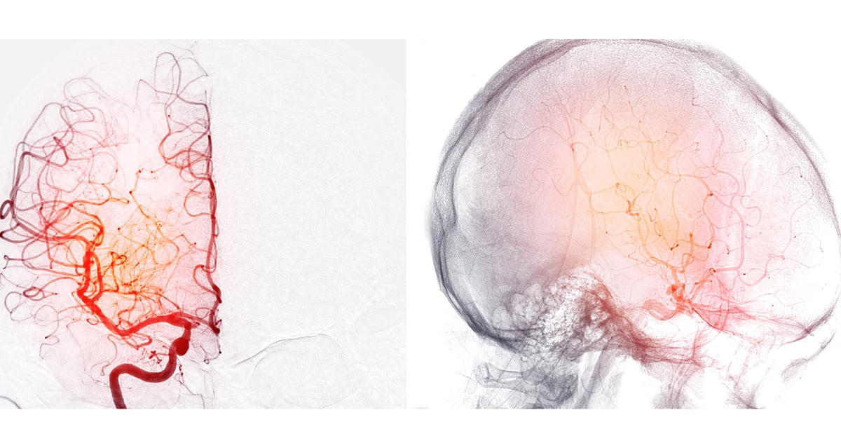 Visualización angiográfica de vasos intracraneales
