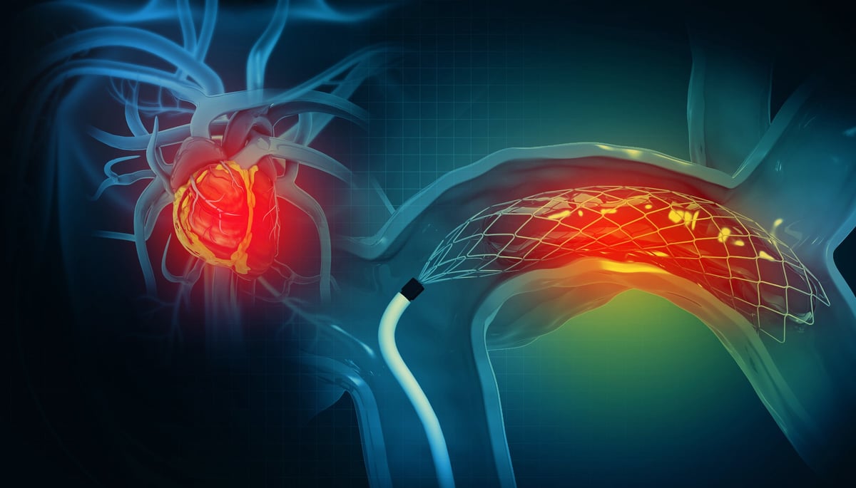 Cateterismo cardíaco — stent coronario avanzando por la arteria durante un procedimiento de intervención coronaria