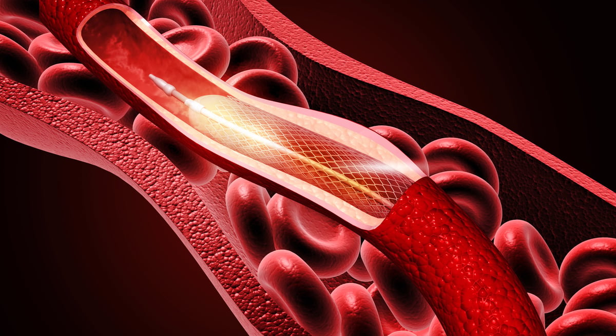 Stent coronario expandiéndose en arteria — dispositivo cardiovascular de alta especialidad CardioBit